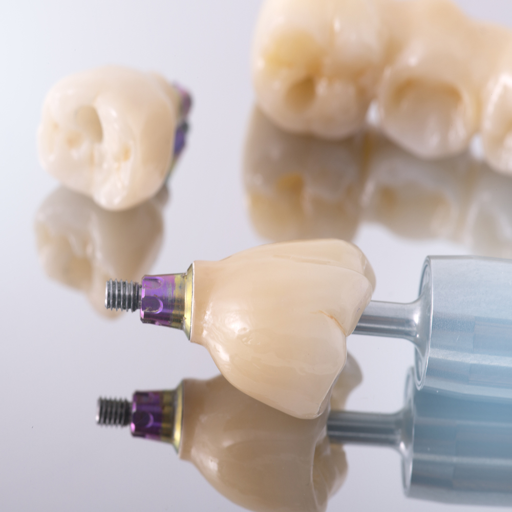 legacy-dental-lab_services_implants_04