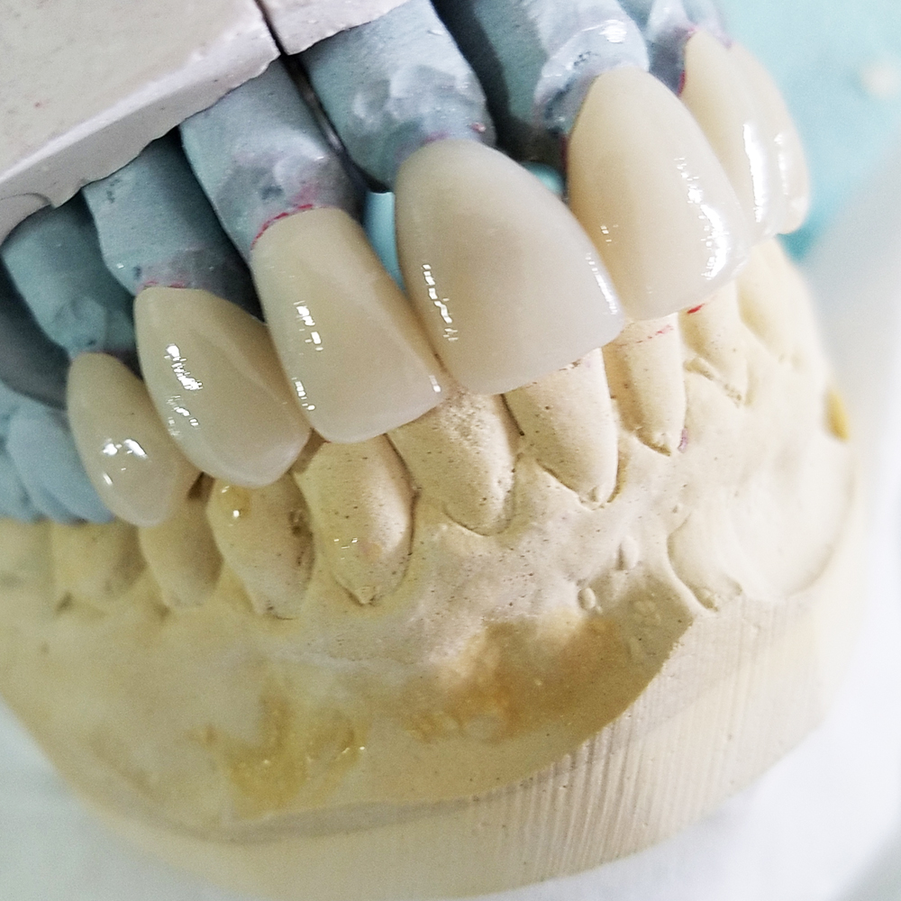 legacy-dental-lab_services_zirconia-crowns_01